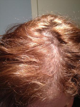 Hair Extensions For Thinning Hair